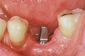 Pilier en Titane vissé sur un implant en position de première molaire inférieure